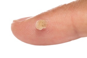 The wart disease of the skin which is effective against a Skincell Pro